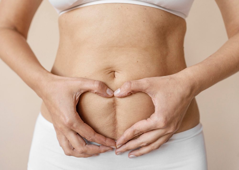 Diastasis recti treatment for core strength at Sport-Fit Physio Care Chennai